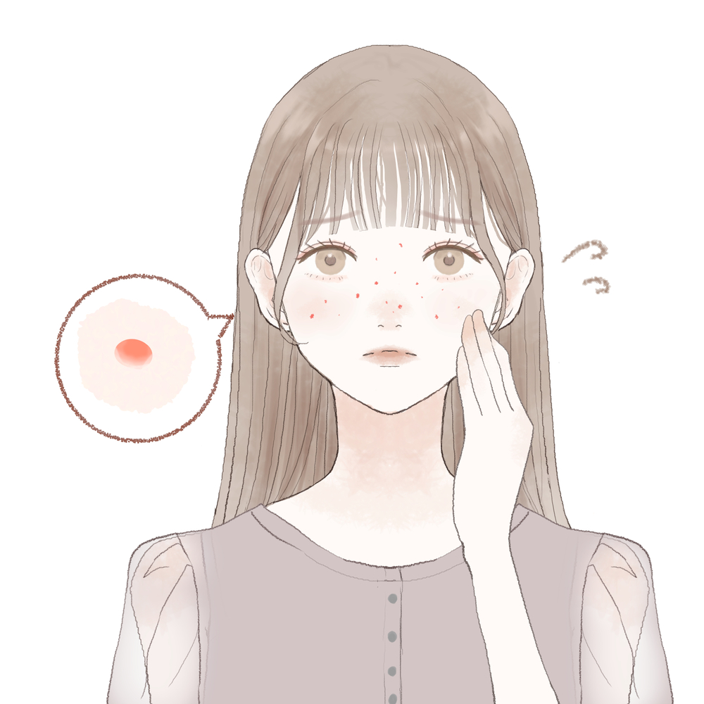 札幌市でニキビ跡を美容診療で相談したい方へ｜赤み・色素沈着・凹凸の考え方